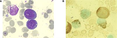 The successful combination of grapefruit juice and venetoclax in an unfit acute myeloid leukemia patient with adverse risk: A case report